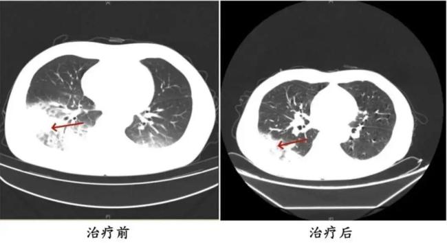 空调不洗就吹究竟有多脏 警惕军团菌危害