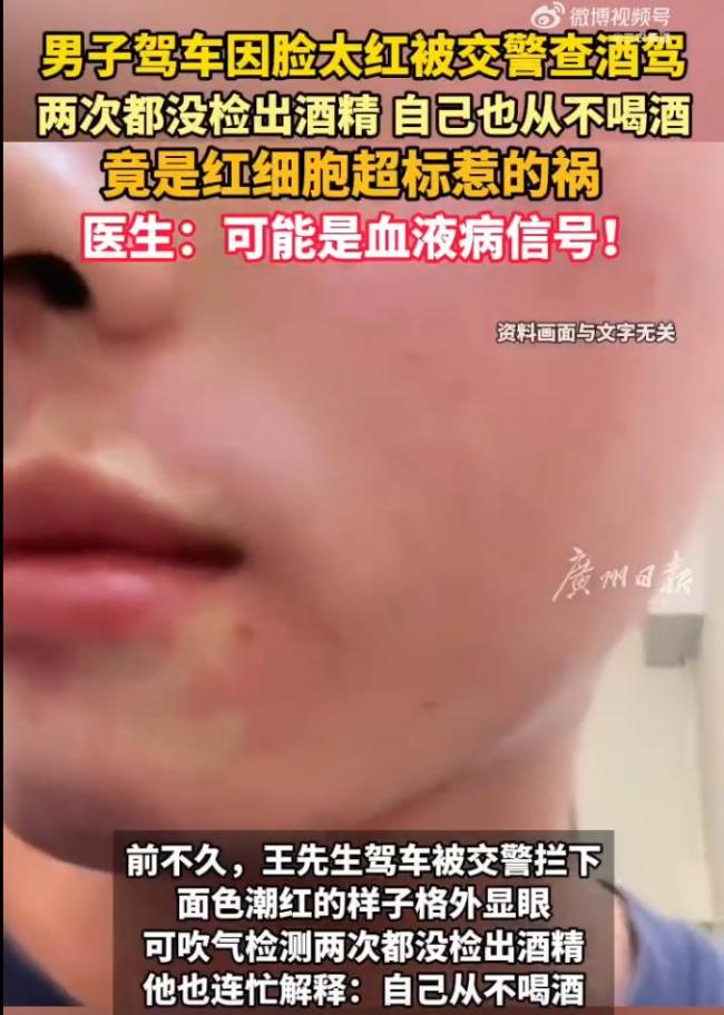 男子脸红被查酒驾竟查出血液病